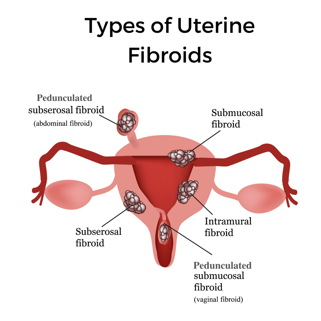 types of fibroids